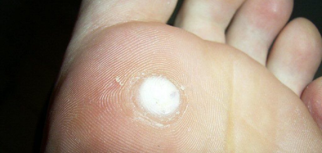  If you are unsure how to disinfect your shoes, please consult a doctor or health professional. Thanks for reading our post about how to disinfect shoes after plantar wart.