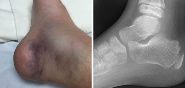 Life After a Calcaneus Fracture | Detailed Guide (2024)